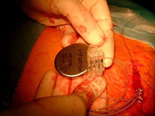 Bild zu OTS - Der neue Vitatron CRT 8000 Herzstimulator