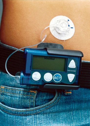 Insulinpumpe Paradigm(R) 512 / Eine Insulinpumpe
imitiert die Insulinabgabe einer gesunden Bauchspeicheldrüse.
Anders als bei Insulin-Injektionen gibt eine Insulinpumpe rund um
die Uhr kontinuierlich Insulin ab und ermöglicht bei Bedarf eine
einfache zusätzliche Bolus-Insulinabgabe.