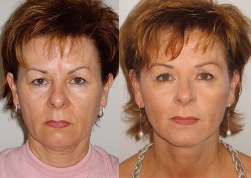 G.A.T.-Institut GmbH, Frau Nachbargauer (48)
vorher/nachher nach 5monatigem Training