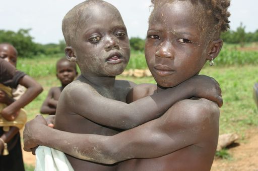 Naziru 4 J. aus Burkina Faso ist blind aufgrund von
Xerophthalmie.