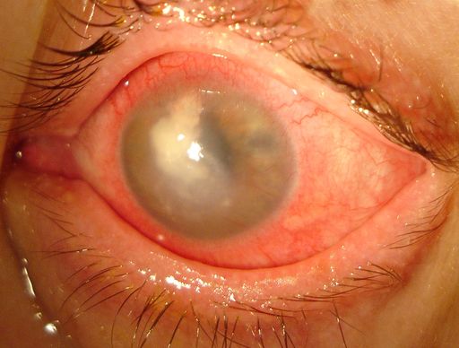 Fall einer schweren Augenentzündung durch einen Kontaktlinsenschaden