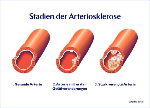 Bei einer Arteriosklerose, auch Arterienverkalkung genannt, lagert sich Fett in die Gefäßwände ein, die dann verkalken und ihre Elastizität verlieren. Das Blut fließt nicht mehr ungehindert und es kann zum Herzinfarkt kommen.