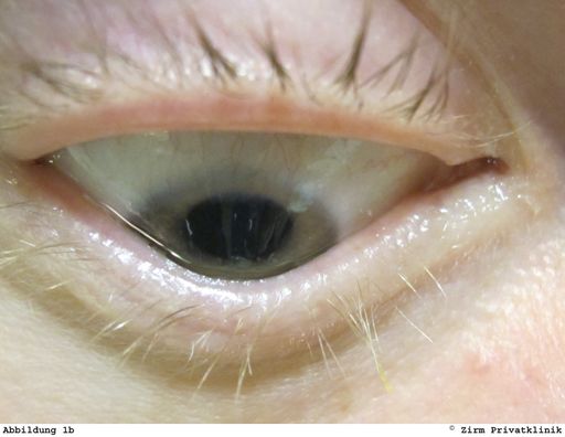 Auge mit Keratokonus. Bei Blick nach unten drückt ein hochgradiger Keratokonus das Unterlid kegelartig vor.