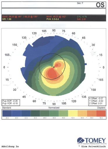 Vorschau Bild von Ein Keratokonus kann nur durch eine Hornhaut-Topographie (siehe Bild) und eine Spezialberechnung (Zernike-Analyse) bewiesen werden, die die Aufsteilung der Hornhaut und deren Position exakt bestimmen lässt.
