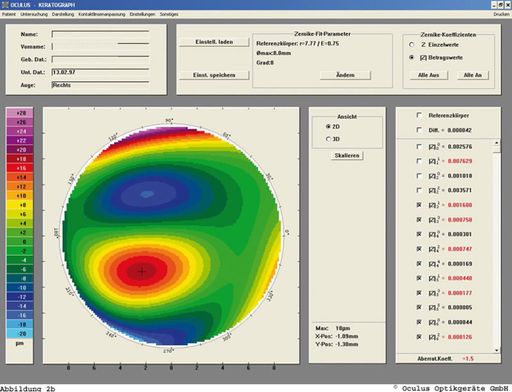 Vorschau Bild von Ein Keratokonus kann nur durch eine Hornhaut-Topographie und eine Spezialberechnung (Zernike-Analyse)(siehe Bild) bewiesen werden, die die Aufsteilung der Hornhaut und deren Position exakt bestimmen lässt.