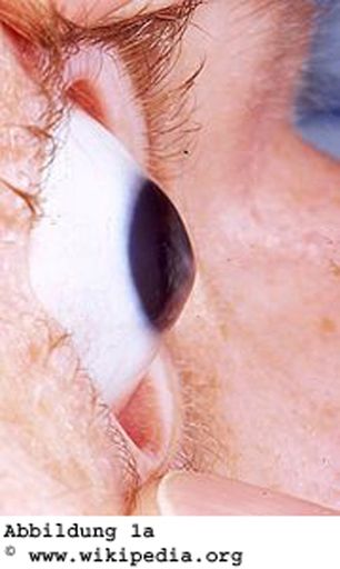 Vorschau Bild von Auge mit Keratokonus. Bei seitlicher Beobachtung ist die Vorwölbung der Hornhaut gut zu erkennen.