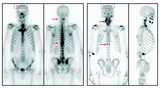 Vorschau Bild von Abb. einer Darstellung von Knochentmetastasen. Links: altes Verfahren - die beiden Bilder rechts mittels "BONESEEKER" IASOflu - exaktere Bildgebung und Detaildarstellungen