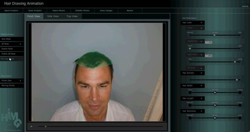 Haartransplantation-Animationssoftware
