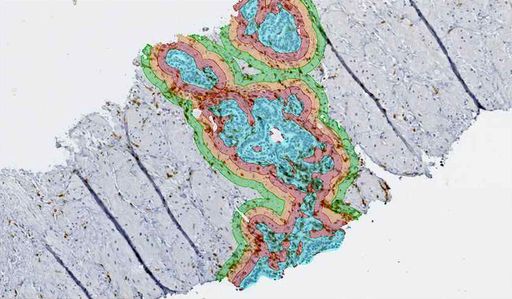 Vorschau Bild von Mit der neuesten Bildverarbeitungsumgebung
StrataQuest ist es nicht nur möglich Gewebestrukturen - hier ein
Prostatakarzinom - automatisiert zu erkennen, sondern auch die an
der Immunabwehr beteiligten Zellen zu quantifizieren und den Abstand
jeder Immunzelle zur nächsten Tumorzelle zu messen.