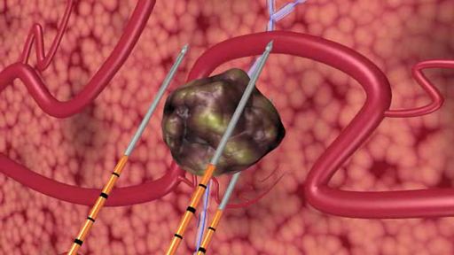 Heidelberger Klinik für Prostata-Therapie nutzt
erstmals die Irreversible Elektroporation zur schonenden Behandlung
von Prostata-Krebs. Das Schema zeigt die Einführung von drei
IRE-Elektroden, die rings um den Prostata-Tumor angeordnet sind; mit
kurzen Spannungsstößen werden die Tumorzellen im Rahmen der
Irreversiblen Elektroporation abgetötet.