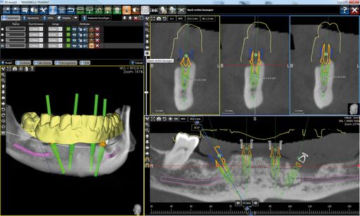 Vorschau Bild von Ansicht virtuelle Implantationsplanung