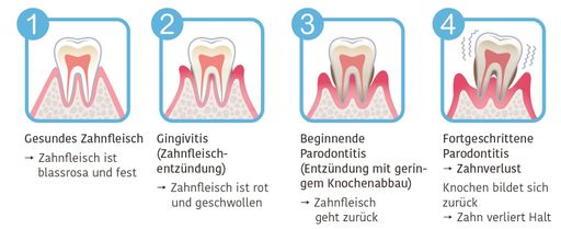 Vorschau Bild von Grafik: Übersicht - Gesundes Zahnfleisch vs. Parodontitis
