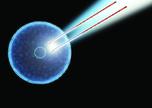 Bei der IRE-Therapie bildet sich um die nadelähnlichen Sonden ein
gepulstes elektrisches Feld, das die Zellmembranen im
Anwendungsbereich öffnet und damit die Zellen zerstört. Da es bei
diesem Verfahren zu keiner Hitzeentwicklung kommt, kann sich das
gesunde Gewebe erholen, während die Krebszellen absterben. Weiterer
Text über ots und www.presseportal.de/nr/57328 / Die Verwendung
dieses Bildes ist für redaktionelle Zwecke honorarfrei.
Veröffentlichung bitte unter Quellenangabe: "obs/Klinik für
Prostata-Therapie Heidelberg/Prostata-Therapie/AngioDynamics"