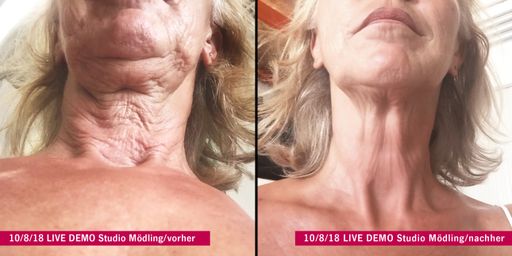 Vorschau Bild von Shape-Line hat damit seine Marktnische erfolgreich
ausgebaut. Neben Abnehmen, Bodyforming und Fitness tritt nun auch
das Thema „FÜR IMMER JUNG“ in den Fokus des Unternehmens. Dass von
dieser Innovation nicht nur Kundinnen, sondern auch die
Studiobetreiberinnen profitieren, liegt auf der Hand. Der große
Neukundenzulauf sowie gesteigerte Pro-Kopf-Umsätze in den
bestehenden Standorten bestätigen diesen positiven Trend. Auch zwei
Studio-Neueröffnungen zeigen, dass die Nachfrage in geographischen
Märkten, in denen Shape-Line derzeit noch nicht präsent ist,
aufgrund dieser neuen Methode immer größer wird.
