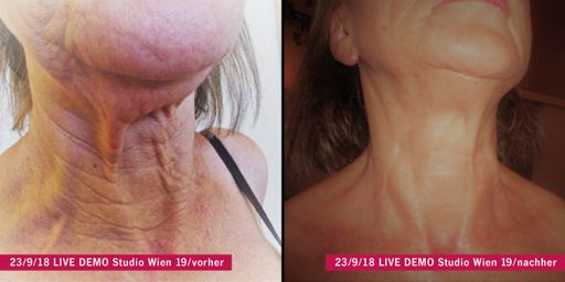 Vorschau Bild von Shape-Line hat damit seine Marktnische erfolgreich
ausgebaut. Neben Abnehmen, Bodyforming und Fitness tritt nun auch
das Thema „FÜR IMMER JUNG“ in den Fokus des Unternehmens. Dass von
dieser Innovation nicht nur Kundinnen, sondern auch die
Studiobetreiberinnen profitieren, liegt auf der Hand. Der große
Neukundenzulauf sowie gesteigerte Pro-Kopf-Umsätze in den
bestehenden Standorten bestätigen diesen positiven Trend. Auch zwei
Studio-Neueröffnungen zeigen, dass die Nachfrage in geographischen
Märkten, in denen Shape-Line derzeit noch nicht präsent ist,
aufgrund dieser neuen Methode immer größer wird.