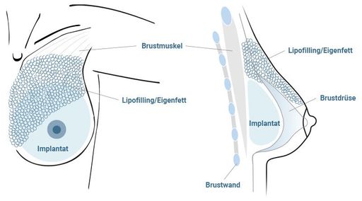 Vorschau Bild von Die PRIME Brustvergrößerung ist ein schonendes Verfahren mit
besonders natürlichen Ergebnissen. Die Brust wird mithilfe von
Eigenfett in Kombination mit einem Implantat vergrößert.
