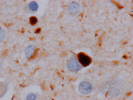 Abbildung von Lewy-Körperchen: Die
Proteinablagerungen im Gehirn verursachen die Lewy-Körperchen-Demenz
(Lewy-Body-Demenz).