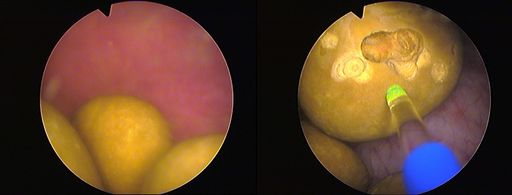 Heidelberger Klinik für Prostata-Therapie kombiniert zwei
Laser-Verfahren / Die Aufnahme links zeigt drei große Blasensteine
vor der Behandlung. Das Bild rechts zeigt die Spitze des
Blasenstein-Lasers während der Lithotripsie; gepulste Energie lässt
den Stein zerplatzen. / Weiterer Text über ots und
www.presseportal.de/nr/57328 / Die Verwendung dieses Bildes ist für
redaktionelle Zwecke honorarfrei. Veröffentlichung bitte unter
Quellenangabe: "obs/Klinik für Prostata-Therapie Heidelberg"