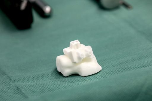 Vorschau Bild von Die Bohrschablone – aufgelegt auf dem
Knochenmodell. Beide Komponenten kommen aus dem 3D-Drucker