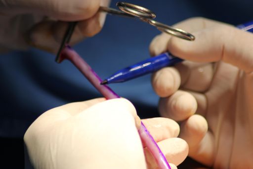 Vorschau Bild von Vascudyne, Inc. announced today the successful first-in-human use
of its TRUE™ Vascular Graft in end-stage renal disease patients
requiring hemodialysis access.