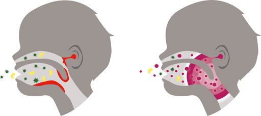 Vorschau Bild von Sind die nützlichen Bakterien der Mundflora reduziert, können
sich schädliche Keime ungehindert im Mundraum und von dort weiter
ausbreiten (links). Eine große Artenvielfalt des Mundmikrobioms
wehrt unerwünschte Keime ab (rechts).