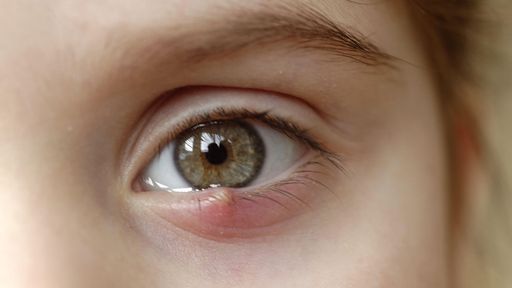 Als Gerstenkörner bezeichnet man eitrige
Schwellungen am Augenlid