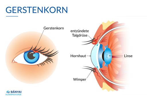 Vorschau Bild von Infografik zum Thema Gerstenkorn