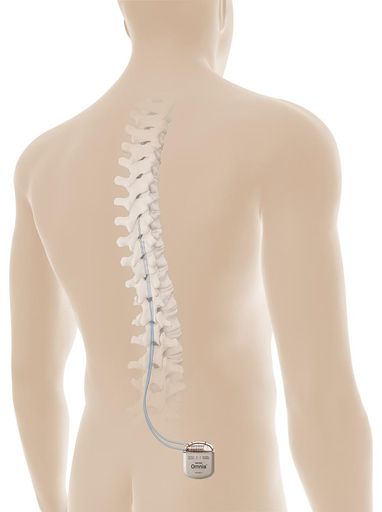  Senza-PDN zeigt, dass die hochfrequente (10-kHz-)SCS eine
wirksame Therapieoption für pharmakotherapierefraktäre Patienten mit
schmerzhafter diabetischer Neuropathie (PDN) sein kann. /
Rückenmarkstimulation wirksam bei therapierefraktärer schmerzhafter
diabetischer Neuropathie / Weiterer Text über ots und
www.presseportal.de/nr/119775 / Die Verwendung dieses Bildes ist für
redaktionelle Zwecke unter Beachtung ggf. genannter
Nutzungsbedingungen honorarfrei. Veröffentlichung bitte mit
Bildrechte-Hinweis.