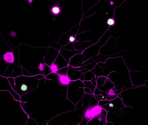 Sensorische Neuronen der Maus sind in Magenta dargestellt. BH4,
das Molekül, das chronische Schmerzen verursacht, ist in Grün
dargestellt. Die Neuronen „im Schmerz" sind also grün/weiß
dargestellt.