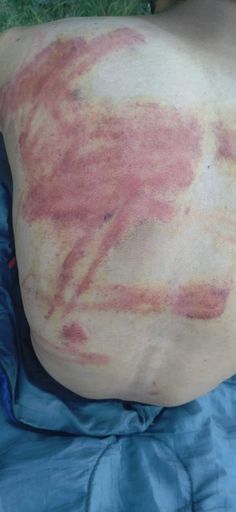 Vorschau Bild von Rücken von Geflüchtetem, der mit Schlagstöcken und
Elektroschocker geschunden wurde