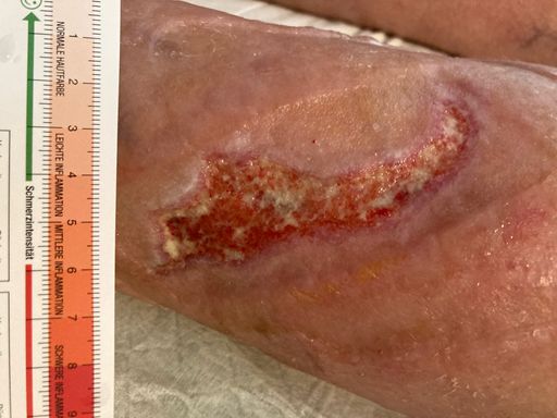 Vorschau Bild von Kaltplasmatherapiezentrum in Eisenstadt Bild 2:
nach 10 Behandlungen . Reduktion der Wundgröße um 90 % am
Unterschenkel