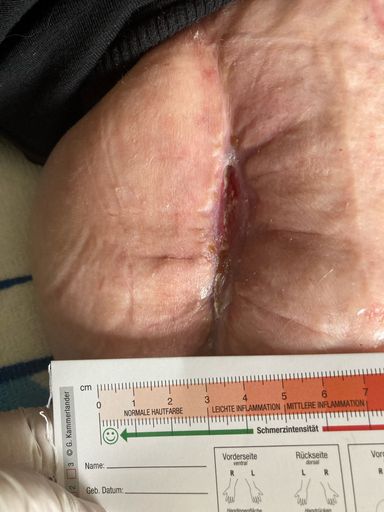 Vorschau Bild von Kaltplasmatherapiezentrum in Eisenstadt Bild 3
Behandlungsbeginn nach Venenentnahme mit Wundheilungstörung