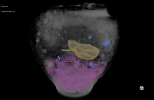 Vorschau Bild von Nachbearbeiteter CT-Scan der Urne 32/2005 aus dem
Gräberfeld Kristein-Ost mit Leichenbrandfragmenten im unteren
Bereich (rosa) und einem Öllämpchen (gelb). Über dem Leichenbrand
sind auch Nägel (blau) und ein weiterer Gegenstand aus Metall (grün)
zu erkennen.