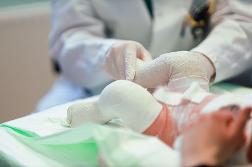 Vorschau Bild von Klumpfußbehandlung nach Ignatió Ponseti: Die
Füßchen werden mit Gipsen in die richtige Position gebracht