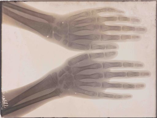 Röntgenaufnahme gesunder Hände aus dem Röntgenlabor
von Guido Holzknecht