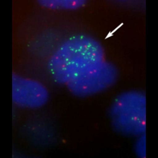 Forscher:innen der St. Anna Kinderkrebsforschung
und der Eberhard Karls Universität Tübingen zeigten, dass eine
Immuntherapie nach einer Stammzelltransplantation bestimmte
Nerventumore (Neuroblastome) bei Kindern nachhaltig bekämpft.
Entscheidend ist dabei, dass durch Stammzellen eines Elternteils
erkrankte Kinder mit einem neuen Immunsystem ausgestattet werden,
das wesentlich besser auf Immuntherapien anspricht. Diese Ergebnisse
einer frühen klinischen Studie wurden im renommierten Journal of
Clinical Oncology veröffentlicht.