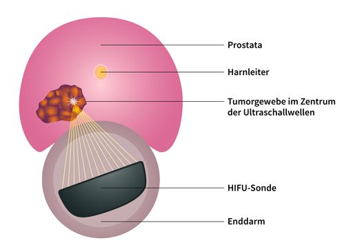 Bei der HIFU-Methode nach dem Sonablate-500-Verfahren wird ein
Tumor vom Enddarm aus mit Ultraschall behandelt; die Schallwellen
bündeln sich im Tumor und zerstören diesen schonend und unblutig.
Dieses fokale Verfahren eignet sich besonders für wenig aggressive
und gut lokalisierbare Tumore und ist eine schonende Alternative zur
klassischen Operation oder Strahlentherapie. / Die Verwendung dieses
Bildes für redaktionelle Zwecke ist unter Beachtung aller
mitgeteilten Nutzungsbedingungen zulässig und dann auch honorarfrei.
Veröffentlichung ausschließlich mit Bildrechte-Hinweis.