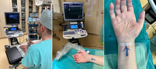 Karpaltunnelsyndrom, minimal-invasive, Ultraschall
gezielte Methode. 3 Schritte der innovativen minimal-invasive,
Ultraschall-gezielte Karpaltunnelsyndrom OP Methode: Untersuchung/OP
Vorbereitung - Vor der Operation - Nach der Operation