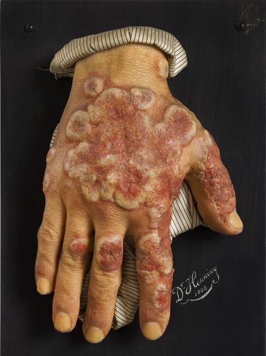 Rötungen und Entzündungen der Haut Erythema
multiforme exsudativum MN.: 17.949 / Moulage, 1908