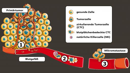 Vorschau Bild von Abbildung 1. Stadien der Metastasenbildung: 1. Lange bevor der
Tumor auch nur 1 Millimeter groß ist, braucht dieser Gefäße, um sich
mit Nährstoffen zu versorgen. 2. Sobald der Tumor mit Gefäßen
versorgt ist, dringen Tumorzellen aktiv in diese ein und werden mit
dem Blut weggeschwemmt. 2. Im Blut werden die Tumorzellen entweder
von Immunzellen abgetötet, oder verstecken sich, indem sie sich mit
Blutplättchen bedecken. 3. Überall im Körper verlassen die
Tumorzellen die Gefäße und bilden Mikrometastasen, kleine Zellhaufen
ohne Gefäße. So überleben sie für Jahre und Jahrzehnte unerkannt. /
Weiterer Text über ots und www.presseportal.de/nr/174468 / Die
Verwendung dieses Bildes für redaktionelle Zwecke ist unter
Beachtung aller mitgeteilten Nutzungsbedingungen zulässig und dann
auch honorarfrei. Veröffentlichung ausschließlich mit
Bildrechte-Hinweis.