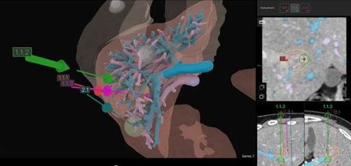 Vorschau Bild von Darstellung der Leber in 3D (links) und 2D (rechts). Die
Lebergefäße sind farbig markiert (Pfortader: blau, Lebervenen:
violett).