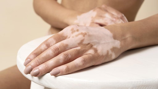  Vitiligo ist eine chronische Autoimmunerkrankung der Haut, die
mit einem Pigmentverlust einhergeht und durch anfangs zartrosa und
vor allem weiße Flecken der Haut sichtbar wird.
