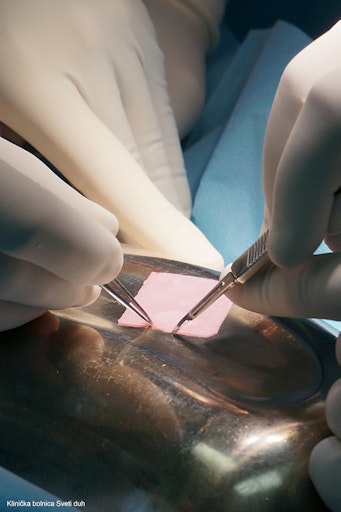 Vorschau Bild von Zuschneiden des Knorpelimplantats – das Implantat wird exakt an
die Form des Knorpelschadens angepasst