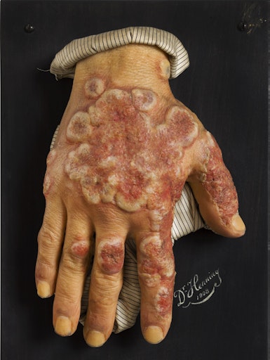 Moulage, 1908 Hauterkrankung