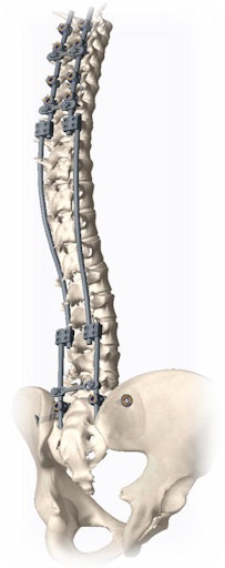 Vorschau Bild von Die neue OP-Methode: Stäbe umspannen die Wirbelsäule und werden
nur am oberen und unteren Ende der Wirbelsäule befestigt. Es erfolgt
kein langer Hautschnitt.