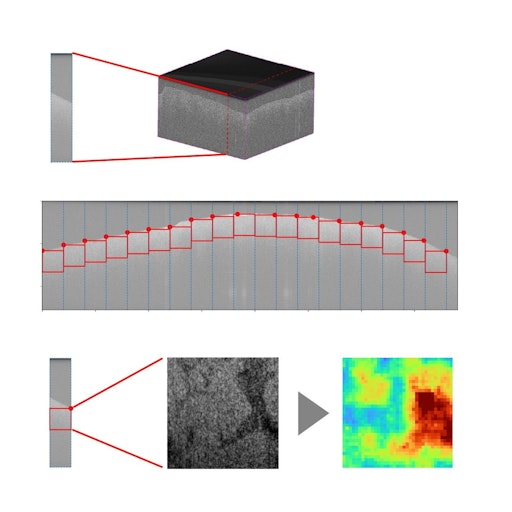 Der dreidimensionale Scan wird in eine Reihe zweidimensionaler
Bilder geschnitten, die wiederum in Kacheln entlang der
Gewebeoberfläche zerteilt werden. Der KI-Algorithmus bewertet für
jede dieser Kacheln, wie sehr das Gewebe vom Normalzustand abweicht
und erkennt Tumorgewebe mit hoher Genauigkeit.