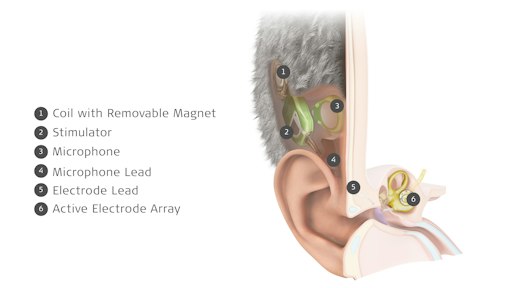 Vorschau Bild von MED-EL führt mit TICI UNICO das weltweit erste und einzige
kommerziell verfügbare unsichtbare Cochlea-Implantat ein.